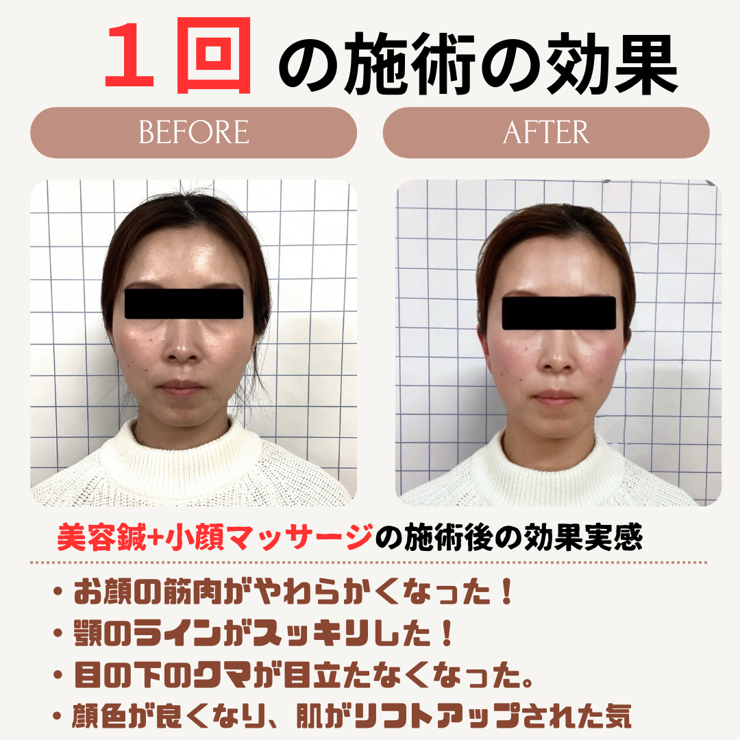美容鍼効果事例