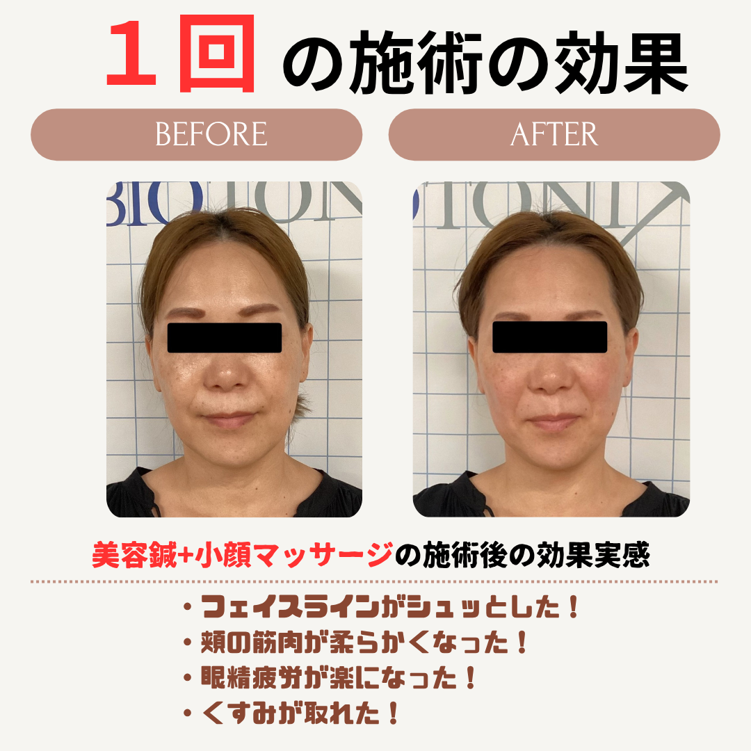 美容鍼効果事例