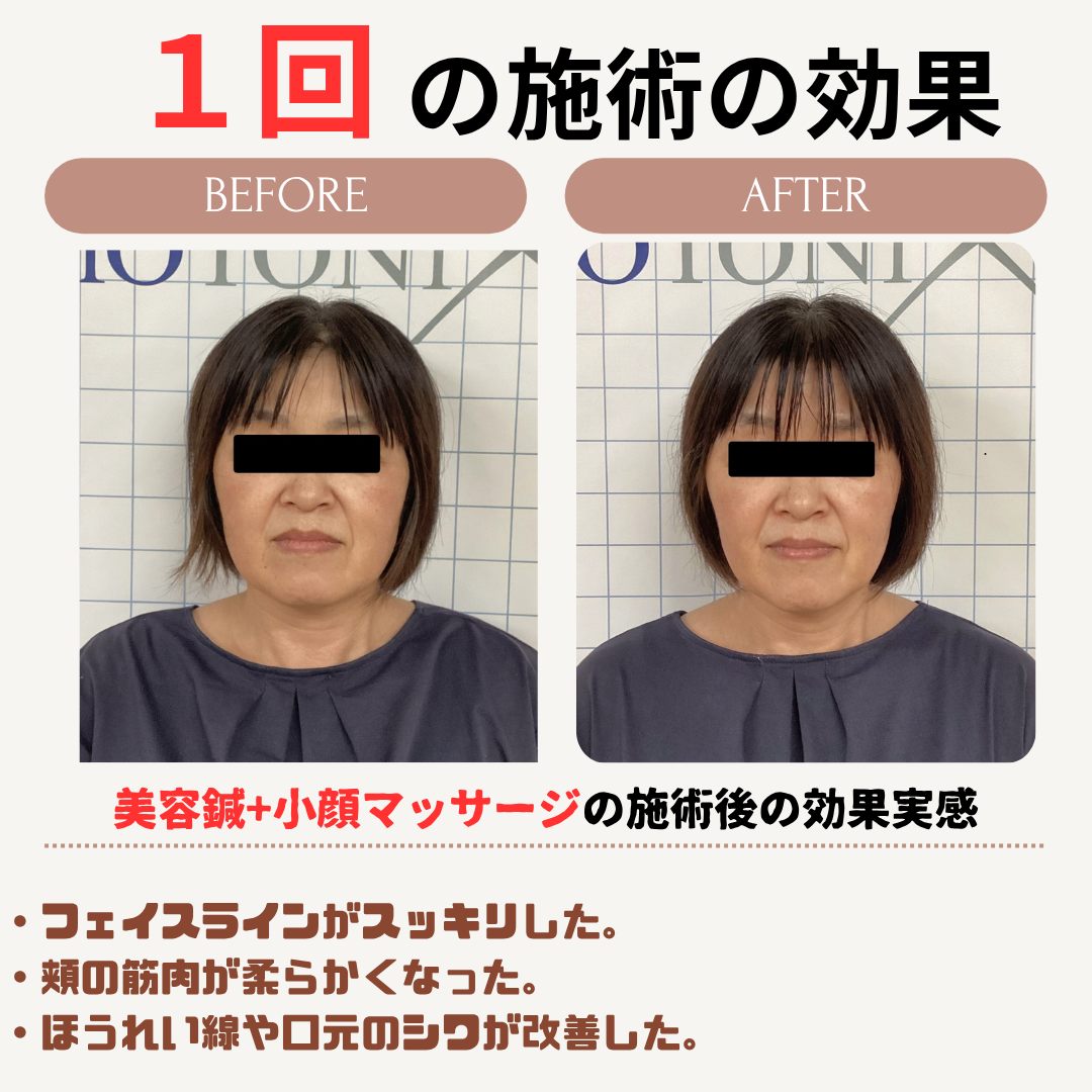 美容鍼効果事例