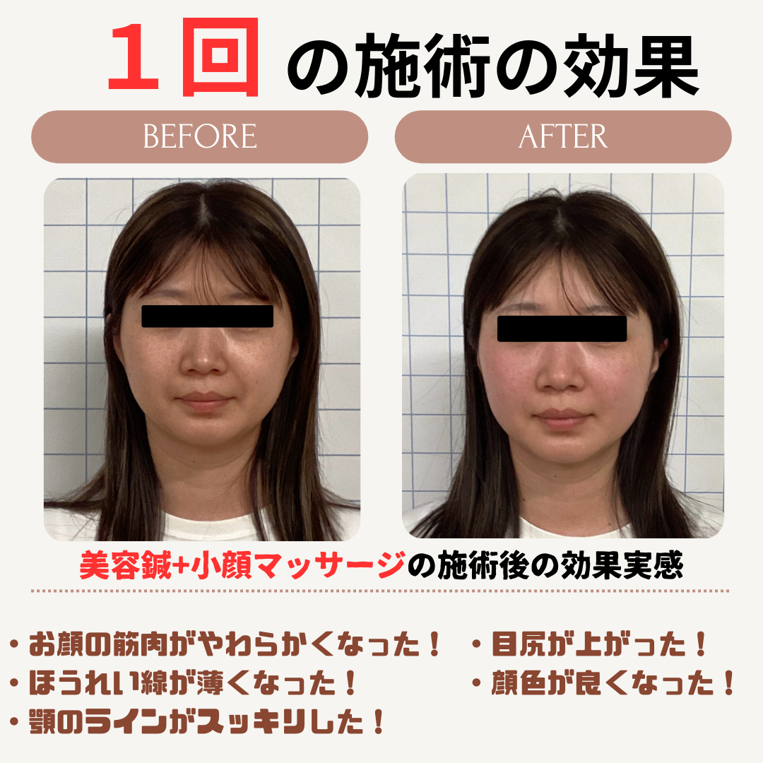 美容鍼効果事例