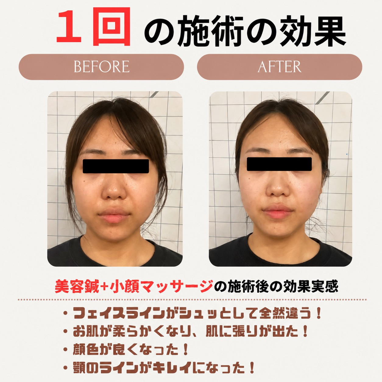 美容鍼効果事例