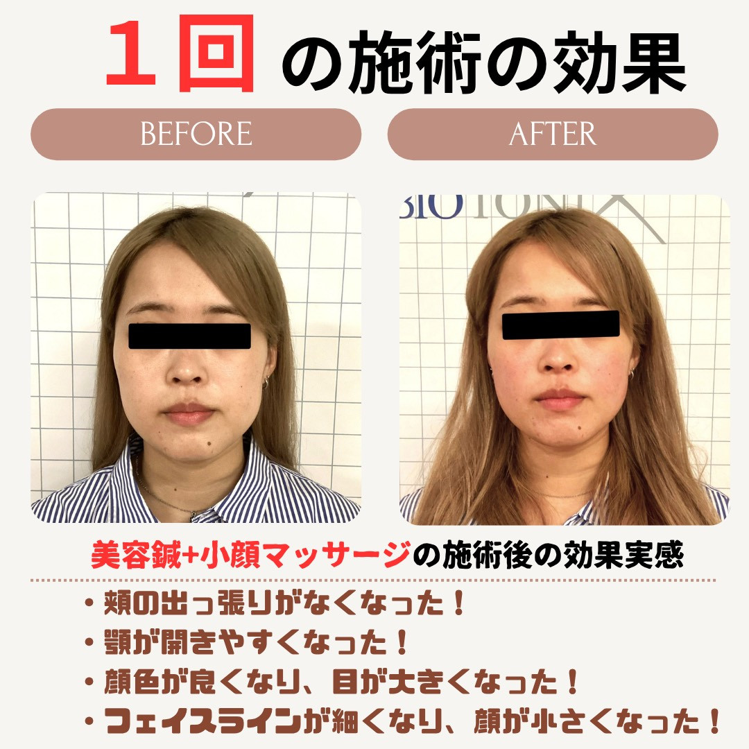 美容鍼効果事例
