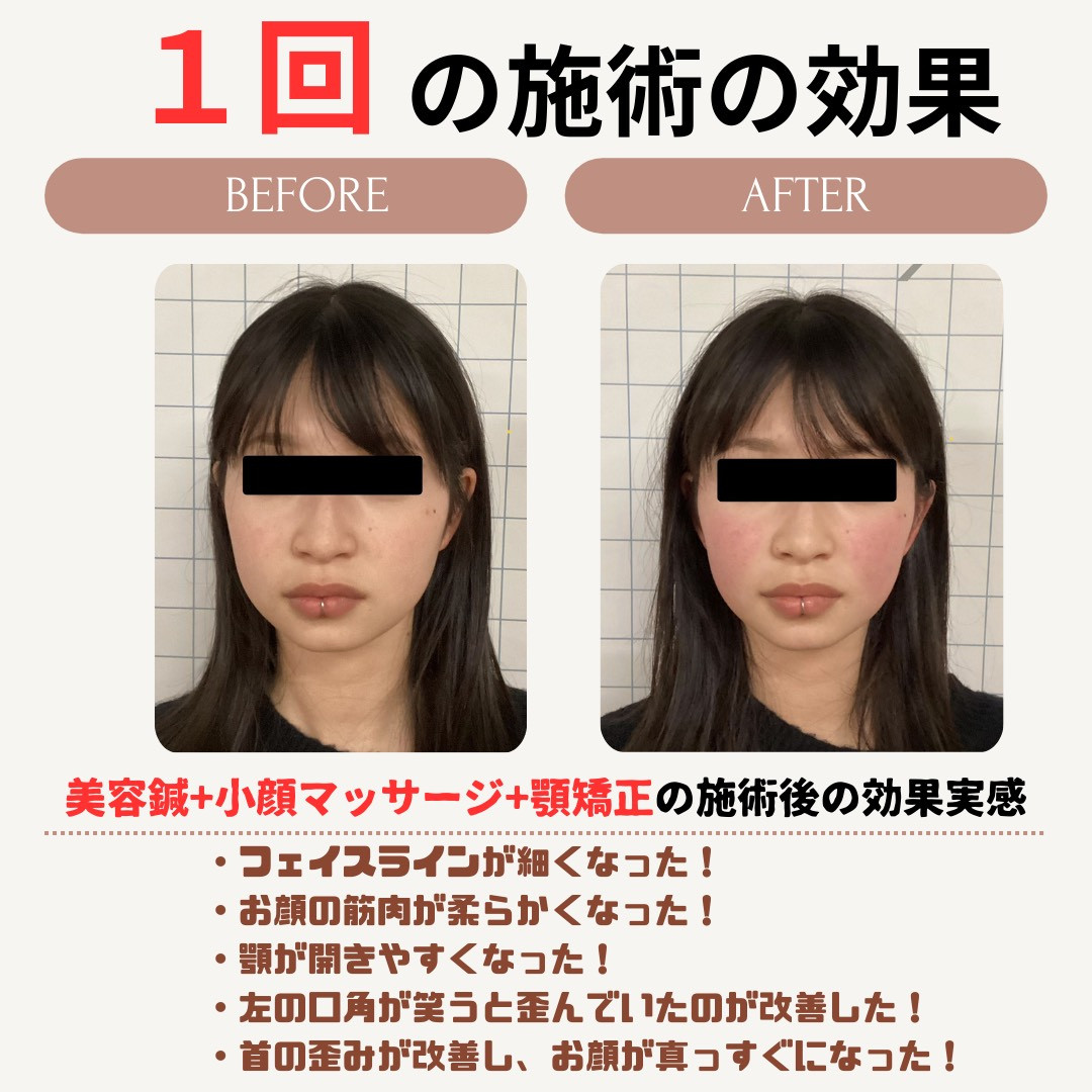 美容鍼効果事例