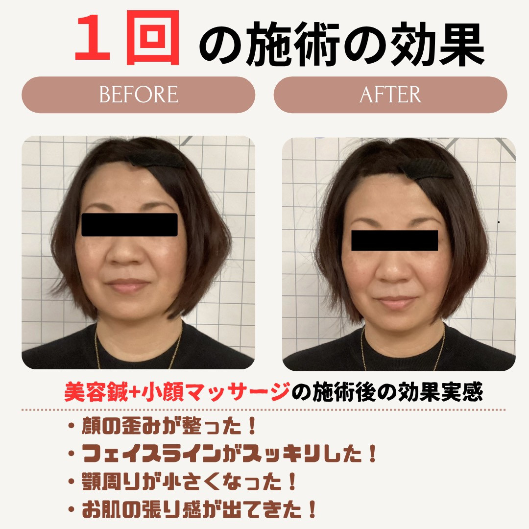 美容鍼効果事例